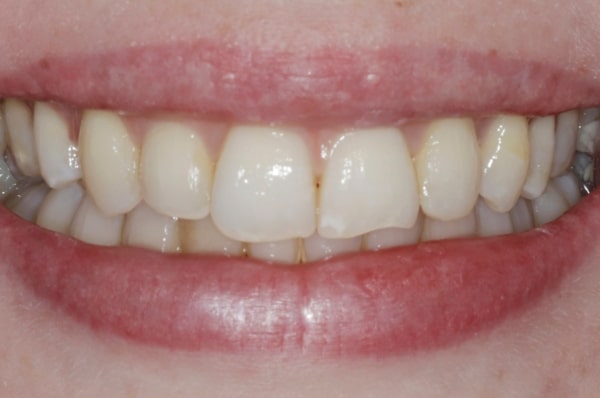 Before - Auckland Cosmetic Dental Clinic
