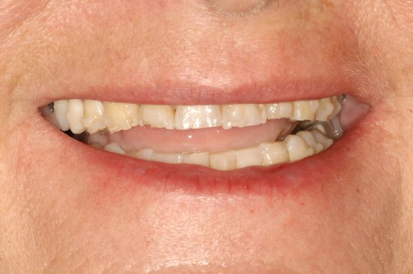 Before - Auckland Cosmetic Dental Clinic