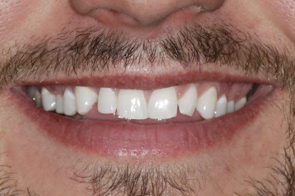 Before - Auckland Cosmetic Dental Clinic