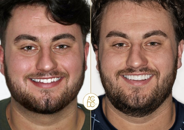 Treatment - Auckland Cosmetic Dental Clinic