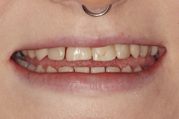 Before - Auckland Cosmetic Dental Clinic