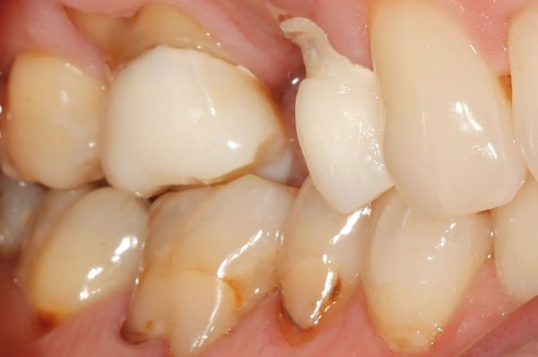 Before - Auckland Cosmetic Dental Clinic