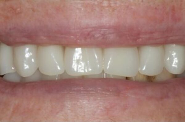 Before - Auckland Cosmetic Dental Clinic