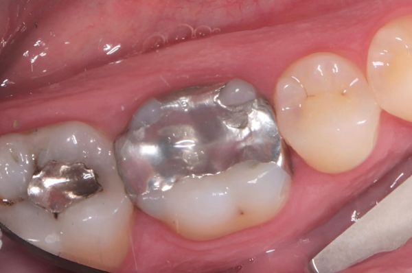 Before - Auckland Cosmetic Dental Clinic